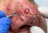 Cystic Blackheads Extraction