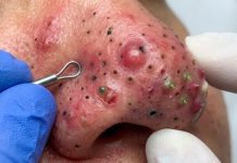 Cystic Blackheads Extraction