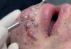 Blackheads Extraction Removal