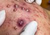 Cystic Blackheads Extraction