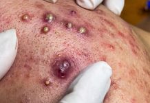 Cystic Blackheads Extraction