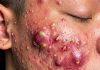 Big Cystic Blackheads Extraction