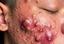 Big Cystic Blackheads Extraction