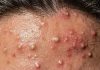 Blackheads Extraction Whiteheads