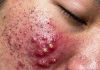 Blackheads Extraction