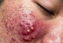 Blackheads Extraction