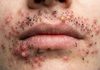 Blackheads Extraction