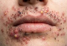 Blackheads Extraction