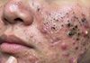 Acne Blackheads Extraction