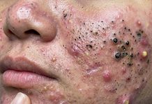Acne Blackheads Extraction