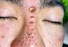 Blackheads Extraction Whiteheads