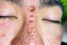 Blackheads Extraction Whiteheads