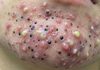 Blackheads Extraction Whiteheads