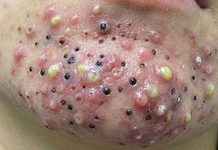 Blackheads Extraction Whiteheads