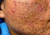 Cystic Acne Extraction Whiteheads