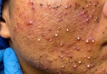 Cystic Acne Extraction Whiteheads