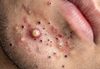 Blackheads Extraction