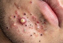 Blackheads Extraction