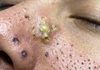Cystic Blackheads Extraction