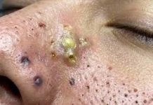 Cystic Blackheads Extraction