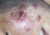 Acne Blackheads Extraction