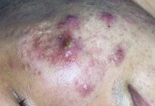Acne Blackheads Extraction