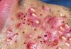 Blackheads Extraction Whiteheads