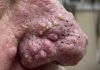 Cystic Blackheads Extraction