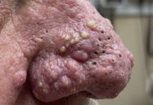 Cystic Blackheads Extraction