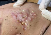 Acne Blackheads Extraction
