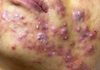 Acne Blackheads Extraction