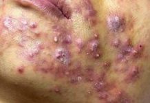 Acne Blackheads Extraction