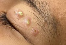 Blackheads Extraction Whiteheads