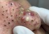 Cystic Blackheads Extraction Whiteheads