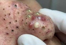 Cystic Blackheads Extraction Whiteheads