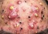Blackheads Extraction Whiteheads