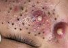 Blackheads Extraction Whiteheads