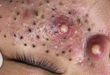 Blackheads Extraction Whiteheads