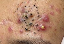Blackheads Extraction Blackheads