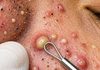Acne Blackheads Whiteheads Removal