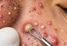 Acne Blackheads Whiteheads Removal