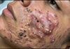 Acne Blackheads Extraction