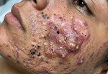 Acne Blackheads Extraction