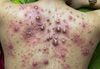 Blackheads Extraction Blackheads