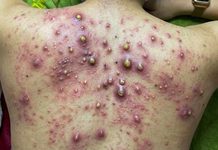 Blackheads Extraction Blackheads