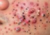 Acne Blackheads Extraction