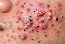Acne Blackheads Extraction