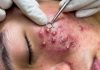 Acne Blackheads Extraction Removal