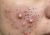 Acne Blackheads Whiteheads