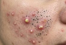 Acne Blackheads Whiteheads